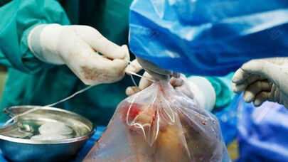 بیمار مرگ مغزی به 6 نفر زندگی دوباره داد